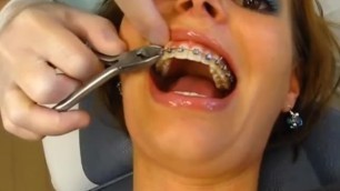 Insanely Hot Girl getting Braces Removed and Retainer Fitted